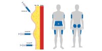 The-Basics-of-Insulin-Injection-Sites-on-body-Where-and-How-to-Inject-v1.jpg